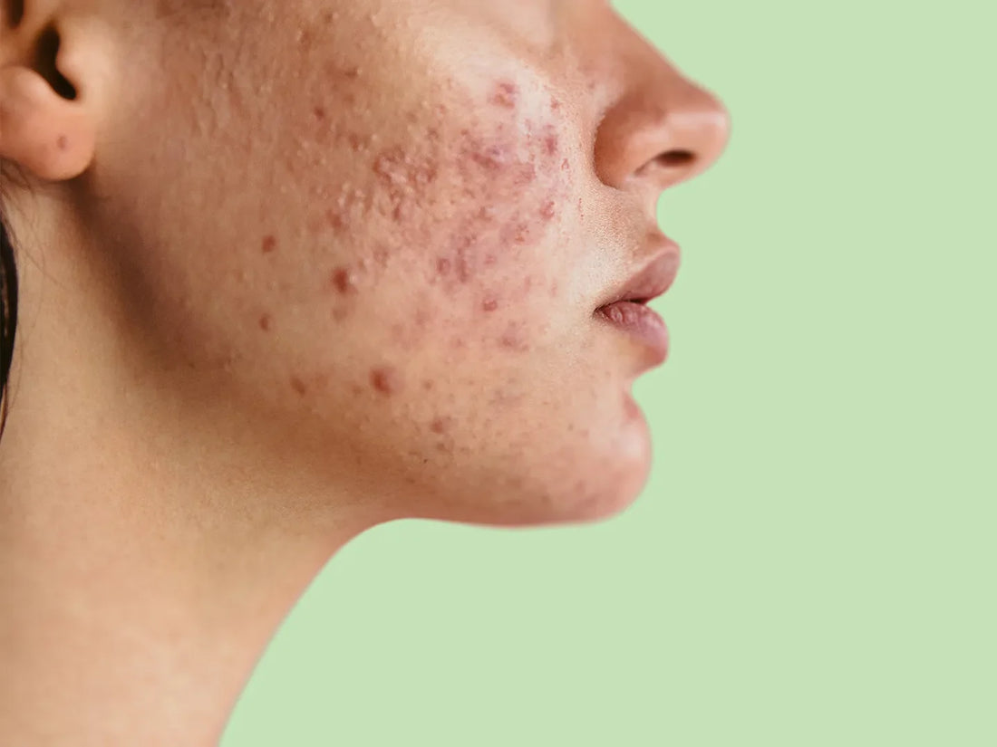 Help! Hormonale acne na het stoppen met de pil